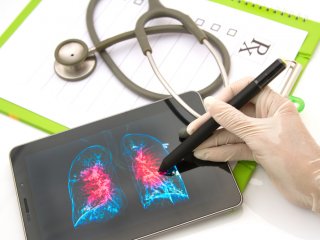 Kidney Disease: Prevention and Treatment Kidney Disease: Prevention and Treatment